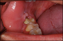 impacted wisdom tooth extraction