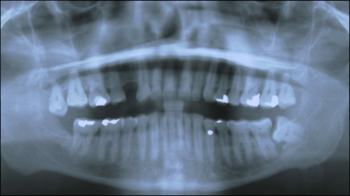 wisdom tooth eruption