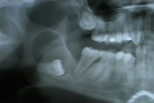 lower impacted wisdom teeth