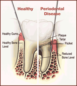 What Are Gums (Gingivae)?