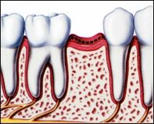 Dental Implants - Anacapa Oral Surgery Dental Implant Center