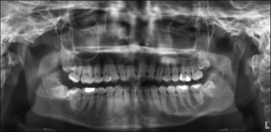 impacted front teeth