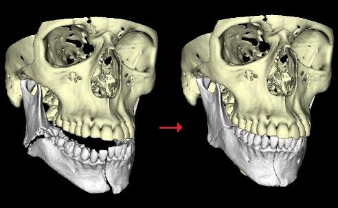 Why Do The Stitches In My Gums Hurt?