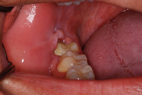 canker sore on cheek near wisdom tooth