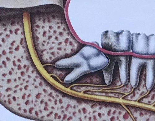 lower impacted wisdom teeth